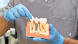 Dental Implant Services
