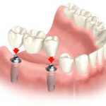 Tooth Restorations