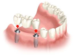 Tooth Restorations