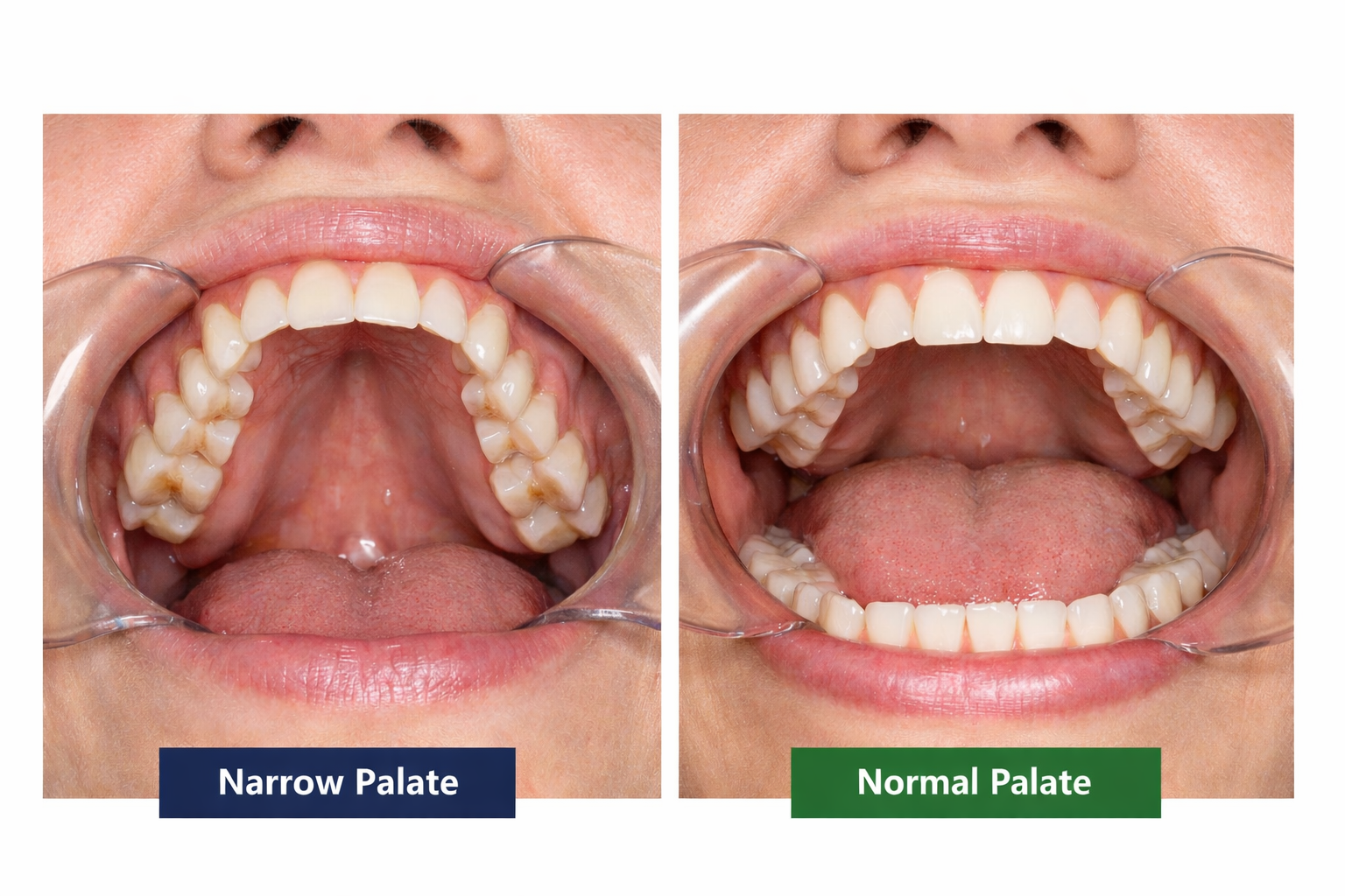 Narrow Palate Vs Normal Palate Key Differences